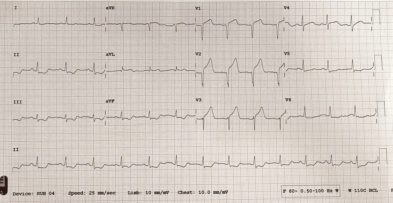 An ECG demonstrates the extensive antero-septal-lateral myocardial infarction [heart attack] that Taryn witnessed.